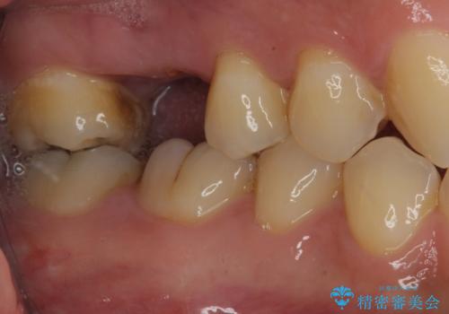 放置していたむし歯　抜歯即時埋入インプラントで負担を軽減の治療前