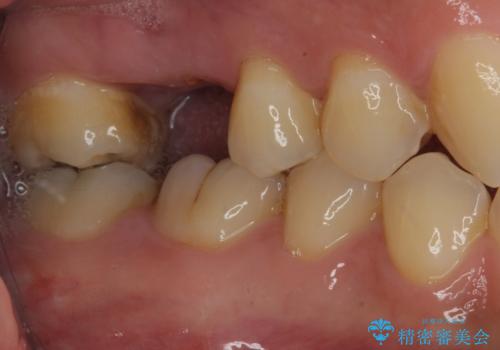 放置していたむし歯 抜歯即時埋入インプラントで負担を軽減の治療前