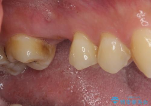 放置していたむし歯　抜歯即時埋入インプラントで負担を軽減の治療前