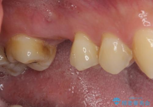 放置していたむし歯 抜歯即時埋入インプラントで負担を軽減の治療前