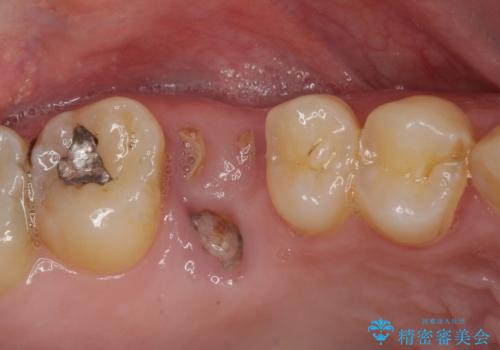 放置していたむし歯　抜歯即時埋入インプラントで負担を軽減の治療前