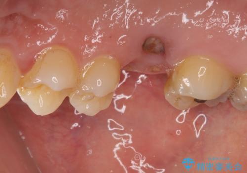 放置していたむし歯　抜歯即時埋入インプラントで負担を軽減の治療前