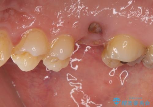 放置していたむし歯 抜歯即時埋入インプラントで負担を軽減の治療前
