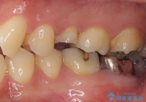 放置していたむし歯　抜歯即時埋入インプラントで負担を軽減の治療前