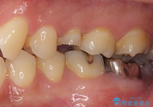放置していたむし歯 抜歯即時埋入インプラントで負担を軽減の治療前