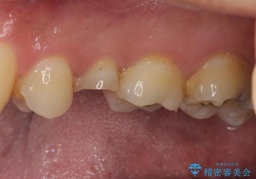 放置していたむし歯 抜歯即時埋入インプラントで負担を軽減の治療前
