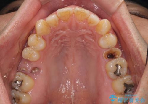 放置していたむし歯　抜歯即時埋入インプラントで負担を軽減の治療前