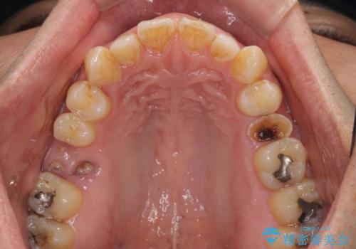 放置していたむし歯 抜歯即時埋入インプラントで負担を軽減の治療前
