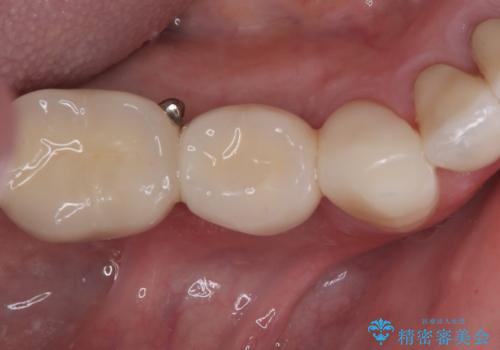 強い咬合力で歯が割れる 1DAYインプラントで歯を守りながら治療の症例 治療後