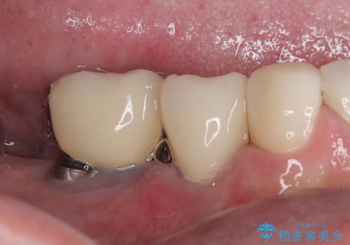 強い咬合力で歯が割れる 1DAYインプラントで歯を守りながら治療の治療後