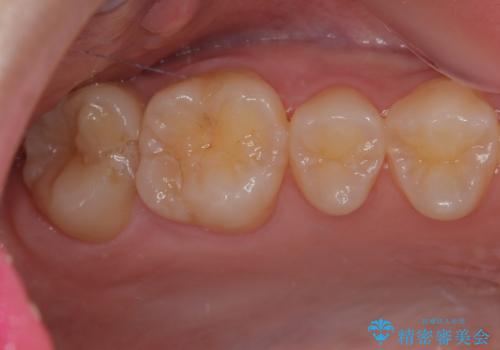 はじめて虫歯ができた　ゴールドインレー修復の治療前