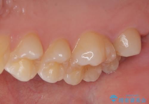 はじめて虫歯ができた ゴールドインレー修復の治療前