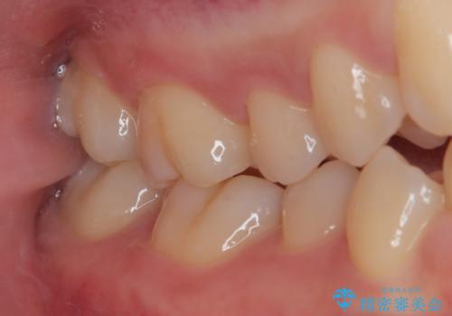 はじめて虫歯ができた ゴールドインレー修復の治療前