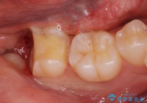 斜めに生えてきている親知らずを抜きたいの治療中