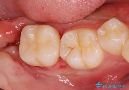 斜めに生えてきている親知らずを抜きたいの症例 治療後