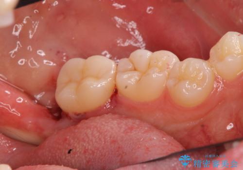 斜めに生えてきている親知らずを抜きたいの治療後