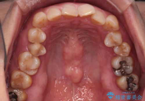 インビザラインで非抜歯矯正|ゴムかけで下顎犬歯の低位を改善し、噛み合わせも最適化の治療前