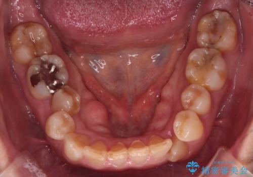 インビザラインで非抜歯矯正|ゴムかけで下顎犬歯の低位を改善し、噛み合わせも最適化の治療前