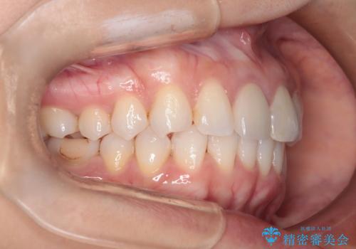 根管治療と並行して矯正を マウスピース治療の治療後