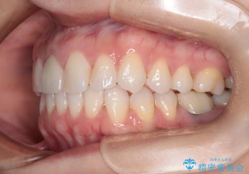 根管治療と並行して矯正を マウスピース治療の治療後