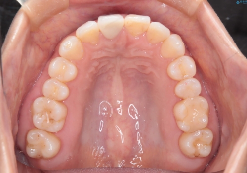 根管治療と並行して矯正を　マウスピース治療の治療後