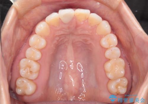 根管治療と並行して矯正を マウスピース治療の治療後