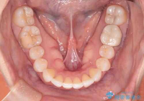 根管治療と並行して矯正を マウスピース治療の治療後