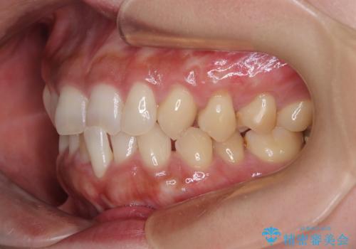 冷たいものがしみる 歯肉移植術で根面被覆の治療後