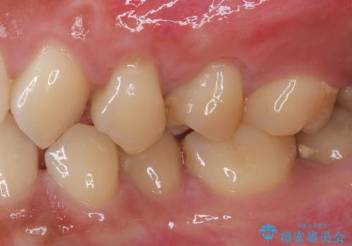 冷たいものがしみる 歯肉移植術で根面被覆の治療後
