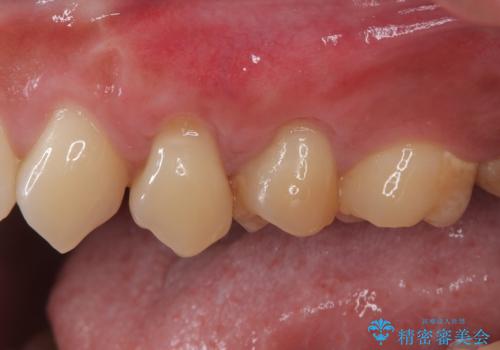 冷たいものがしみる 歯肉移植術で根面被覆の症例 治療後