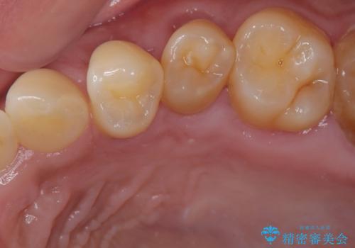 冷たいものがしみる 歯肉移植術で根面被覆の治療後