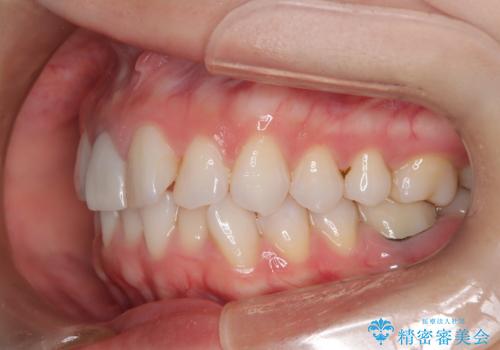 根管治療と並行して矯正を マウスピース治療の治療前