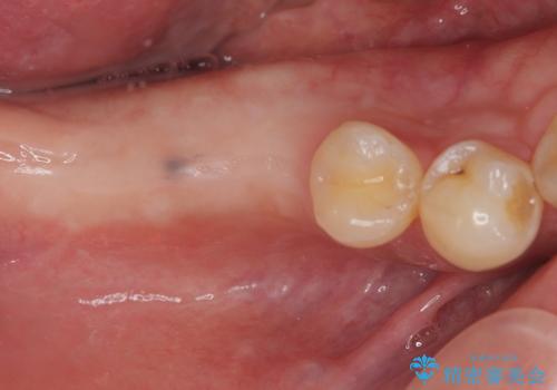 抜歯したところにインプラント治療をしたい。の治療前
