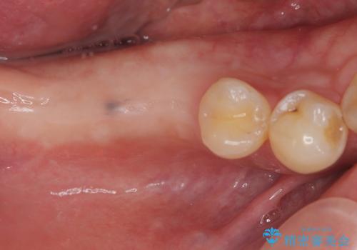 抜歯したところにインプラント治療をしたい。の症例 治療前