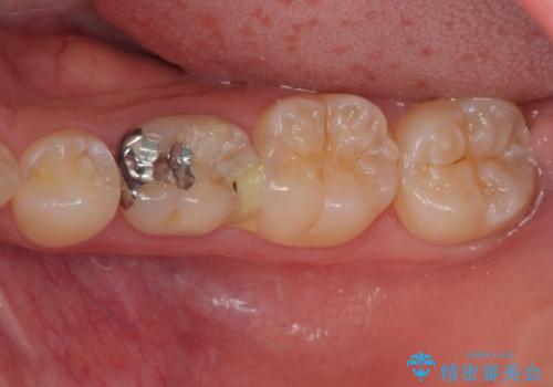 乳歯に虫歯ができた オールセラミッククラウンの症例 治療前