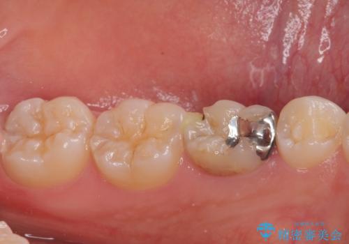 乳歯に虫歯ができた オールセラミッククラウンの治療前