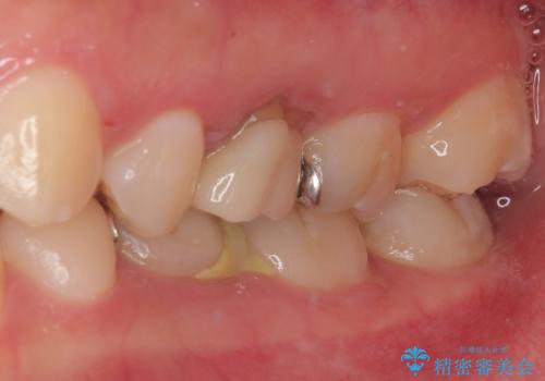 乳歯に虫歯ができた オールセラミッククラウンの治療前