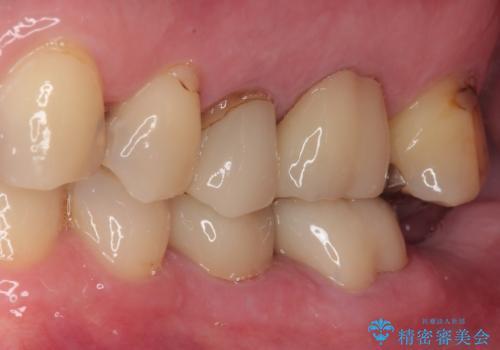 銀歯が取れたのでやり替えたい セラミックインレー修復の治療前