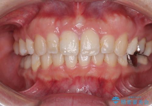 気になる出っ歯を治したい ワイヤー装置の抜歯矯正でスッキリした横顔にの症例 治療後