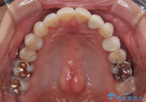 むし歯と前歯のデコボコを治したい　インビザラインを使用した総合歯科治療の治療後