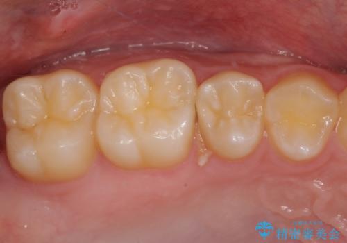 歯間部の自分では気づきにくい虫歯　セラミックインレー修復の治療前