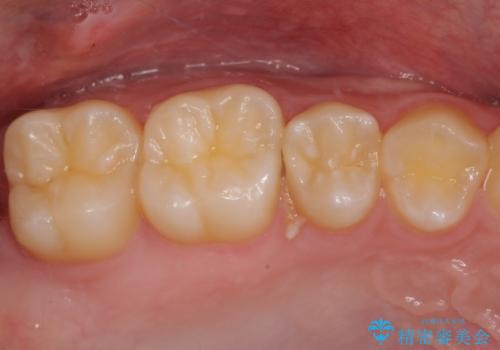 歯間部の自分では気づきにくい虫歯 セラミックインレー修復の症例 治療前
