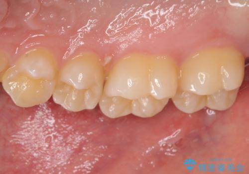 歯間部の自分では気づきにくい虫歯 セラミックインレー修復の治療前