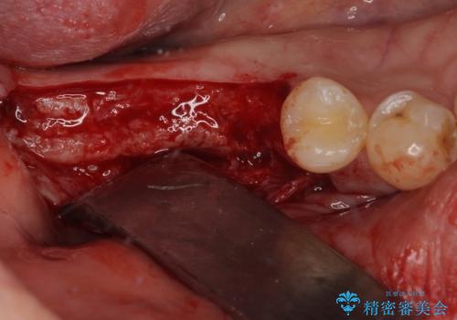 抜歯したところにインプラント治療をしたい。の治療前