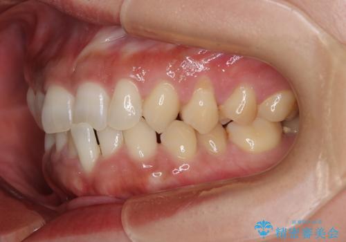 冷たいものがしみる 歯肉移植術で根面被覆の治療前