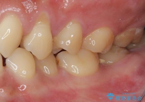 冷たいものがしみる 歯肉移植術で根面被覆の治療前