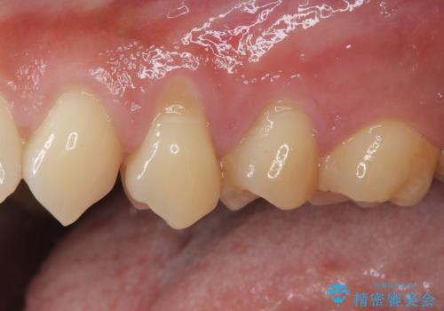 冷たいものがしみる 歯肉移植術で根面被覆の症例 治療前
