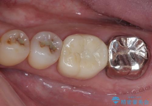 外れてしまった奥の銀歯 オールセラミッククラウンによる補綴治療の症例 治療後