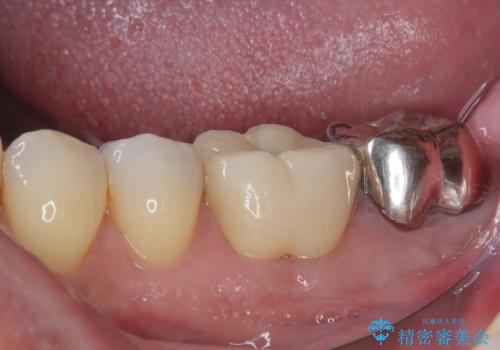 外れてしまった奥の銀歯 オールセラミッククラウンによる補綴治療の治療後