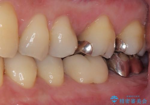 外れてしまった奥の銀歯 オールセラミッククラウンによる補綴治療の治療後